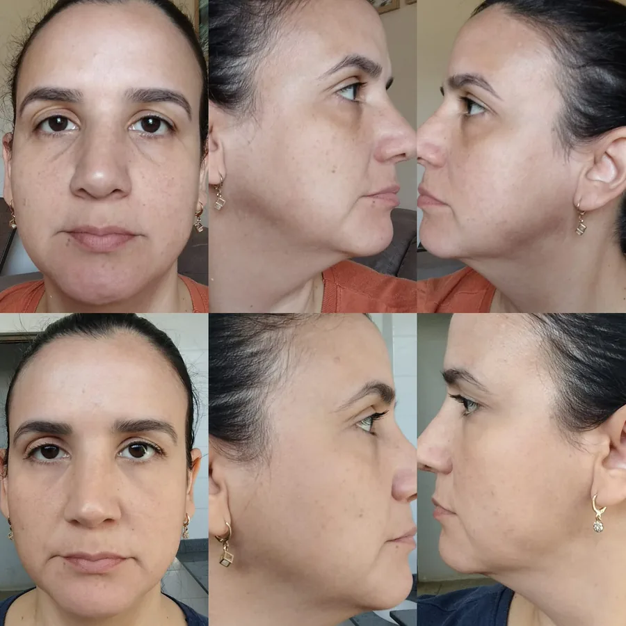 Rosto de uma cliente em três ângulos antes do protocolo, na linha de cima, e os mesmos ângulos após 30 dias, na linha de baixo
